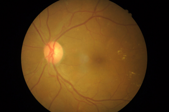 how to find out if you have diabetic retinopathy